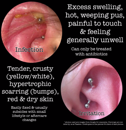 infected ear piercing bump